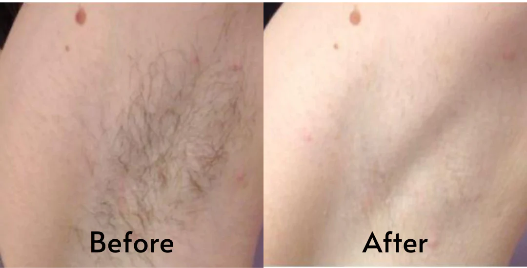 Lumilia IPL laser hair remover device