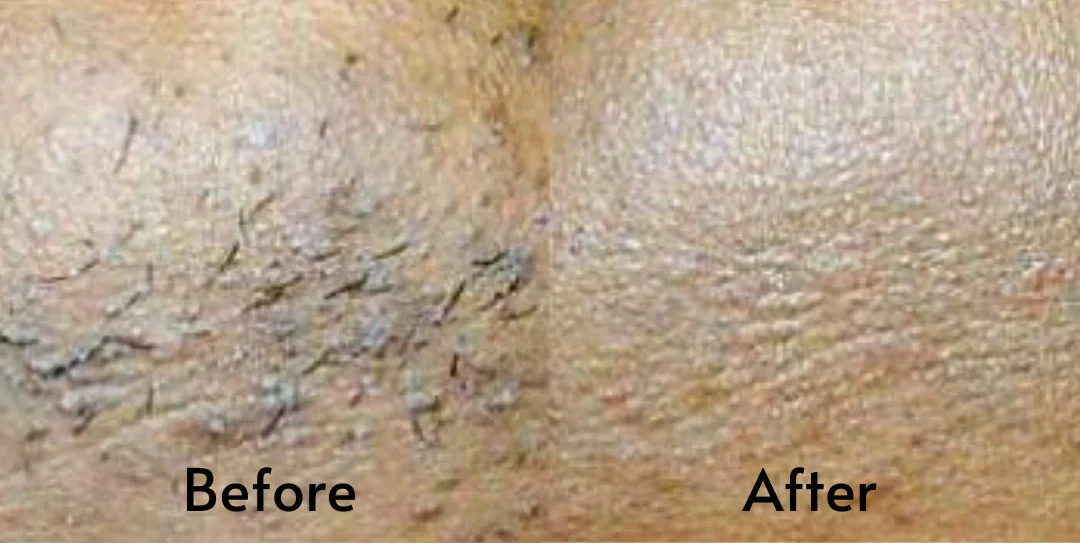 hair removal device